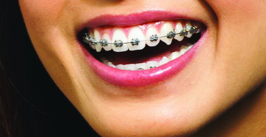 Bild: Festsitzende Zahnspangen